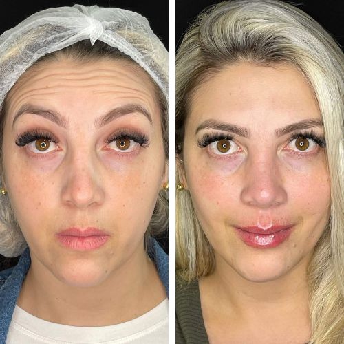 Diminuição de rugas e aumento de volume labial