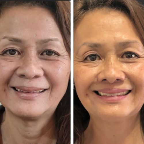Resultado de lip lifting