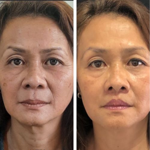 Resultado de lip lifting