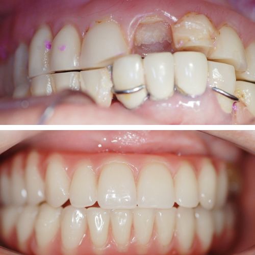 Reconstrução do sorriso com implantes e próteses