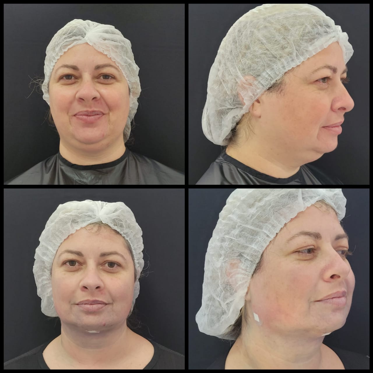 Lipo de papada e bichectomia